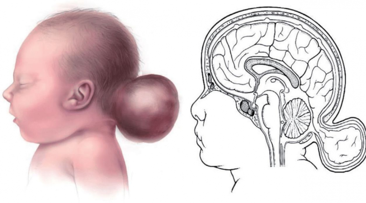 Encephalocele